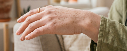 Hyperpigmentation & Dark Spots — What They Are and How to Fade Them